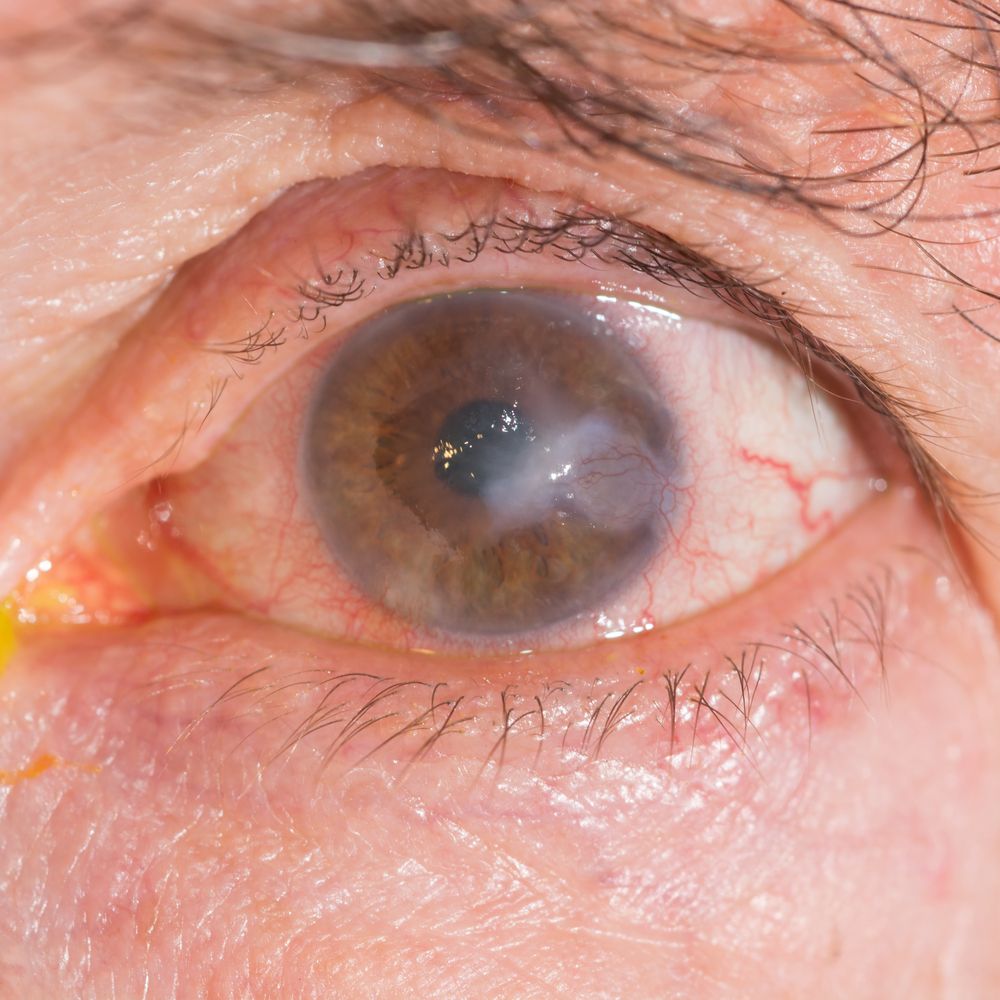 Red eye
